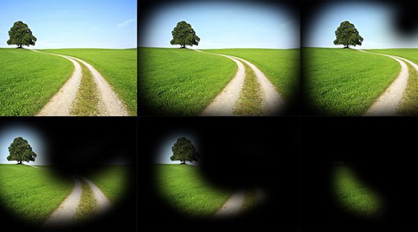 Сужение полей зрения Сужение полей зрения