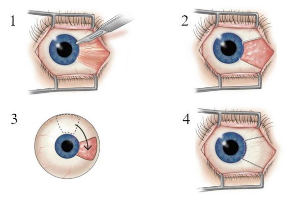 Замещение дефекта Замещение дефекта