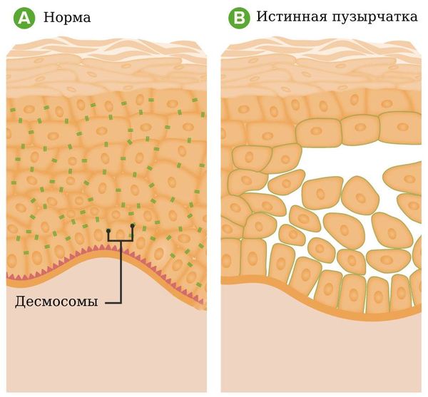 Листовидная пузырчатка