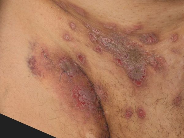 Поражение кожи при вегетирующей пузырчатке [24]