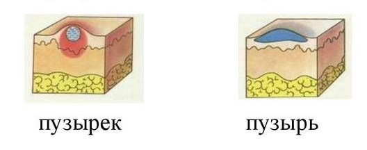 Отличие везикулы (пузырька) от пузыря Отличие везикулы (пузырька) от пузыря
