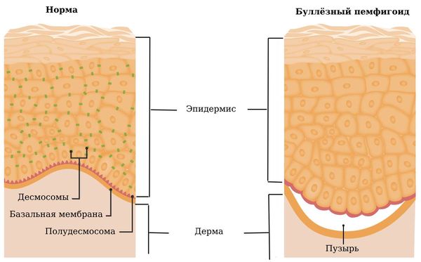 Структура кожи в норме и при буллёзном пемфигоиде Структура кожи в норме и при буллёзном пемфигоиде