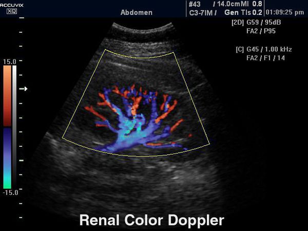 Доплерография (дуплексное сканирование почечного кровотока)