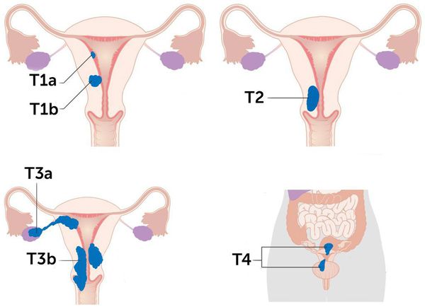 endometrium rák kras)