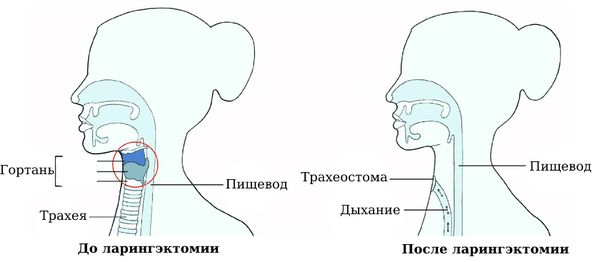 Горло до ларингэктомии и после