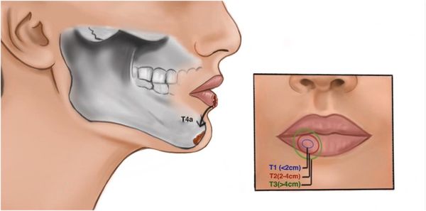Сухие губы: причины, последствия и способы лечения