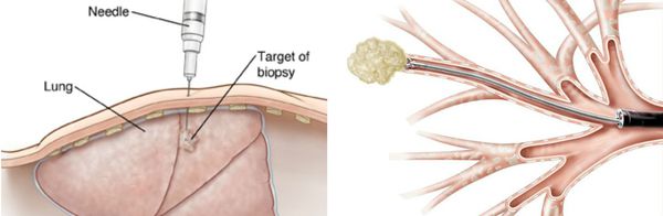 Биопсия посредством разреза или прокола грудной стенки