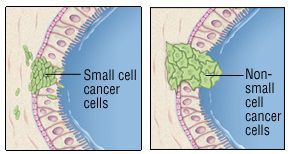 Мелкоклеточный и немелкоклеточный рак