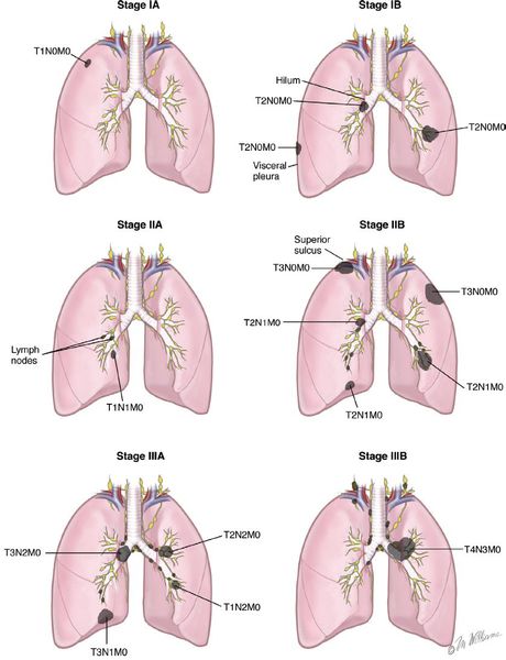 Стадии развития рака лёгкого