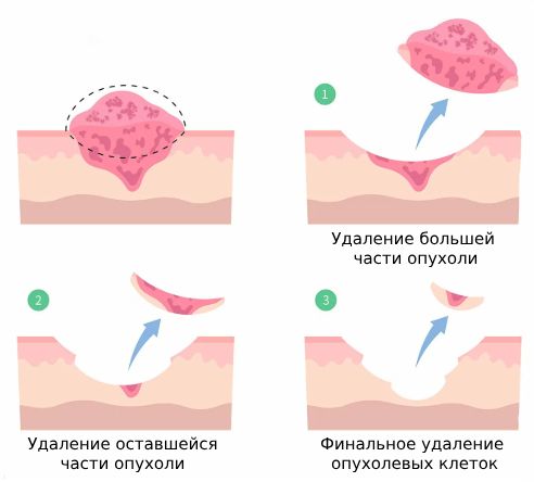 Хирургическое лечение по Мохсу