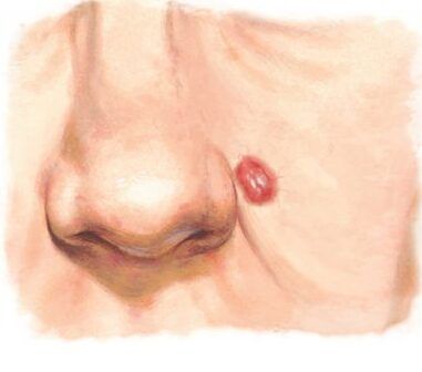 Карцинома Меркеля на лице