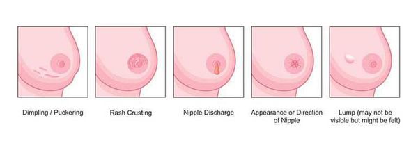Симптомы рака груди