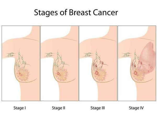 stadii raka grudi s