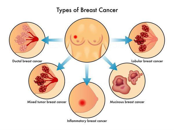 Типы рака груди