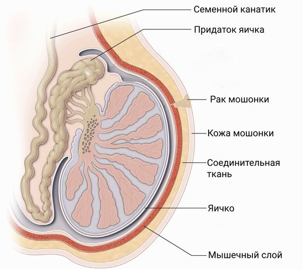 Варикоцеле - признаки, диагностика и лечение у мужчин в Красногорске