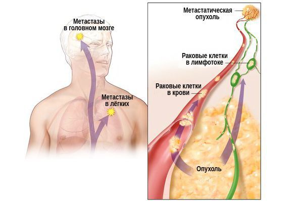 Метастазы опухоли щитовидной железы