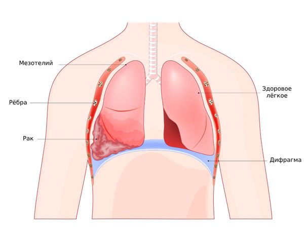 Рак плевры (мезотелиома)