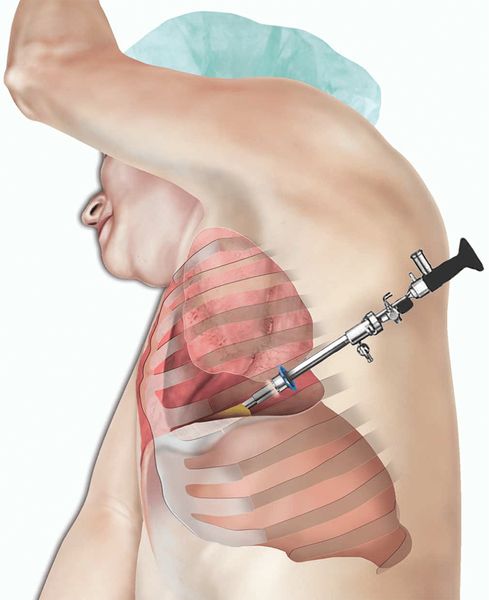 Торакоскопия