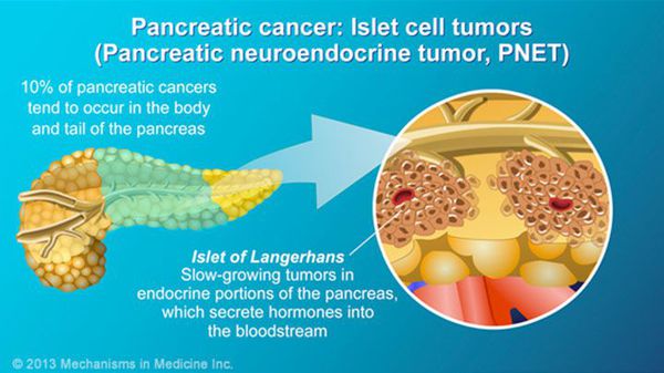 Neuroendocrine tumor of the pancreas