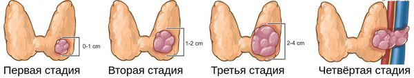 Четыре стадии рака щитовидной железы