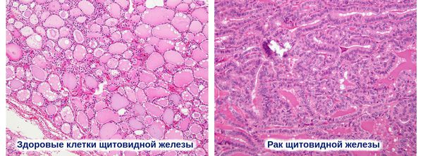 Здоровые и раковые клетки щитовидной железы