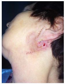 Слюнной свищ [21]