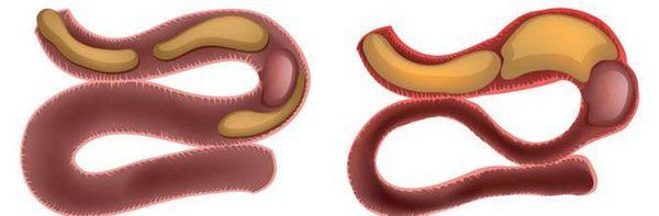 Кишечная непроходимость