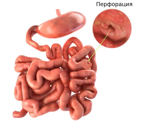 Перфорация тонкой кишки