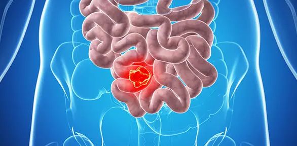Рак тонкой кишки