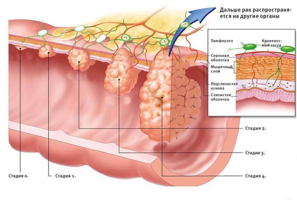 Стадии рака тонкой кишки