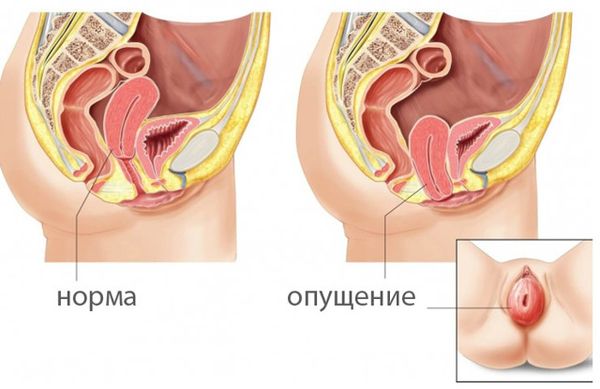 Рак влагалища – Лечение в Киеве – Диагностика и симптомы