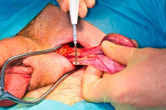 Орхофуникулэктомия. Обработка семенного канатика