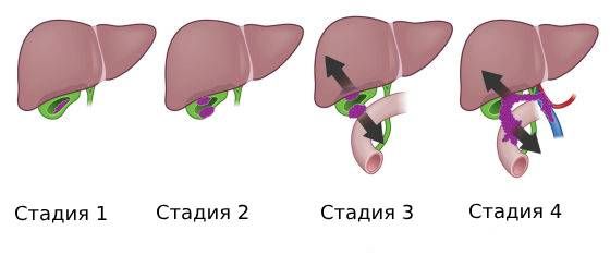 Стадии рака желчного пузыря Стадии рака желчного пузыря