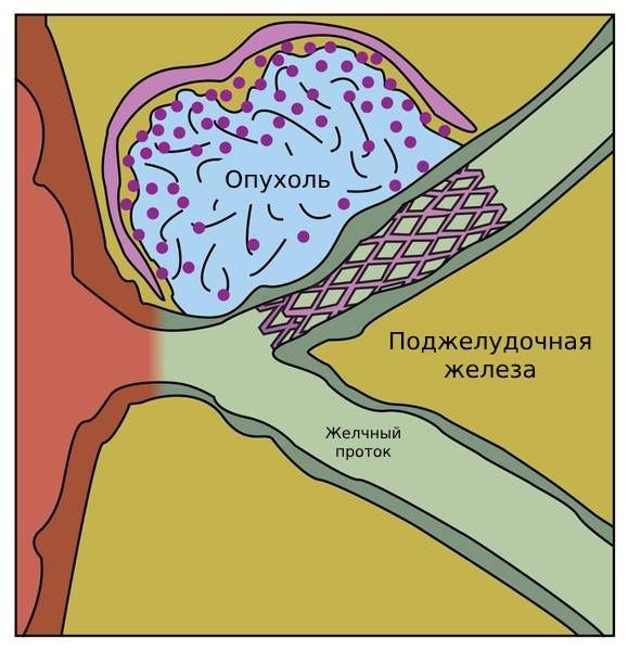 Стент Стент