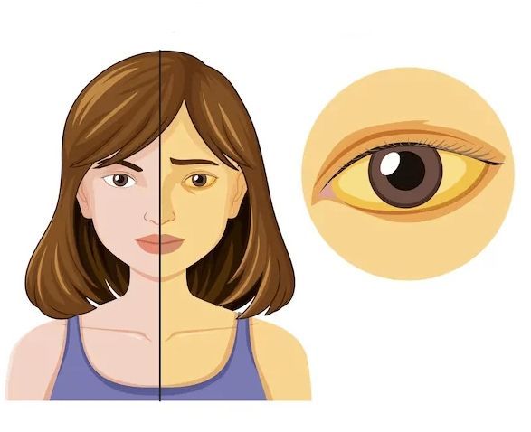 Желтуха Желтуха