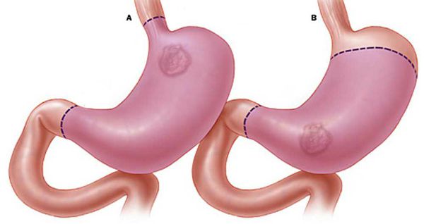 Тотальное (А) и субтотальное (B) удаление желудка