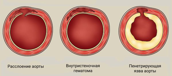 Расслоение аорты рекомендации. Пенетрирующая язва аорты. Внутристеночная гематома аорты.