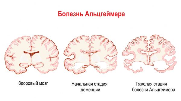 Изменения мозга при болезни Альцгеймера