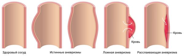 Истинные и ложные аневризмы