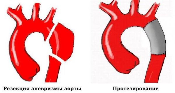 Протезирование аорты