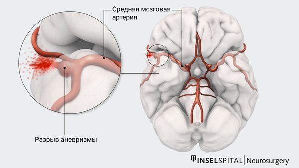 Разрыв аневризмы