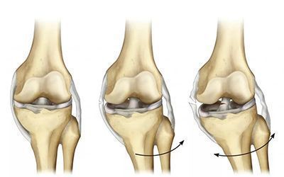 Реабилитация после разрыва связок колена (ПКС)