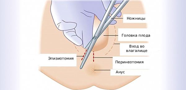 Эпизиотомия и перинеотомия