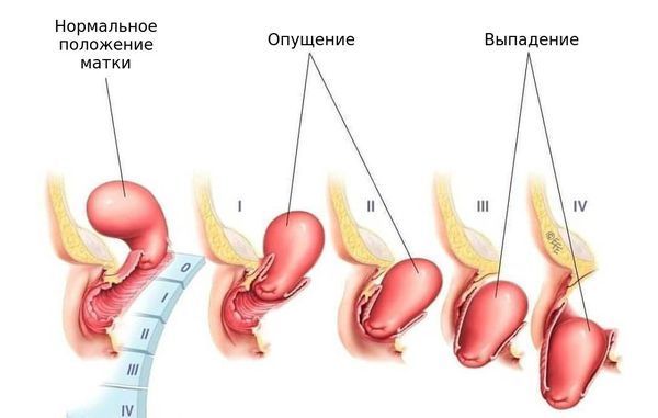 Опущение и выпадение матки