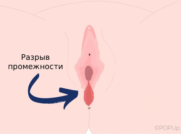 Разрыв промежности