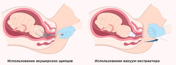 Роды с использованием инструментов