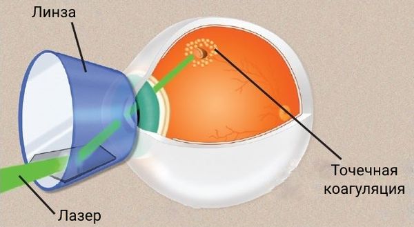 Лазерная коагуляция