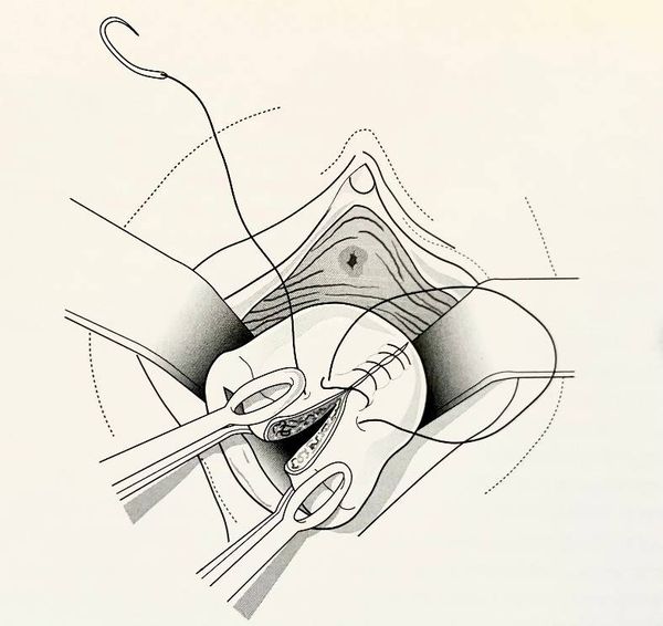 Техника ушивания разрыва шейки матки