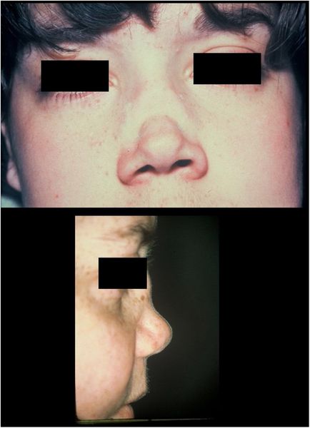 Cедловидная деформация носа [17]
