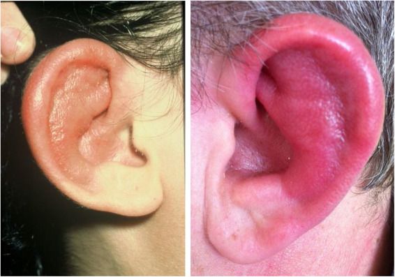 Отёк и покраснение ушной раковины [17]